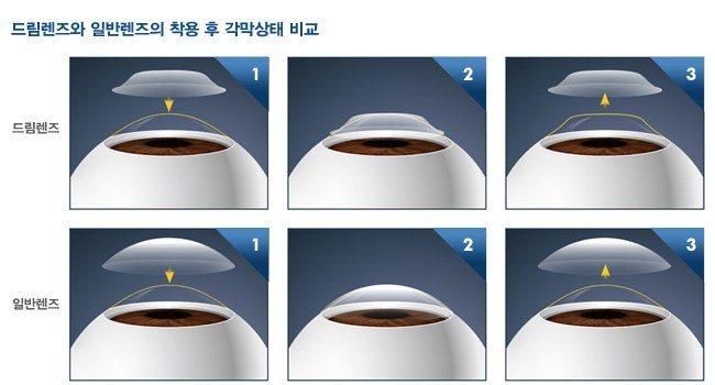 드림렌즈와 일반렌즈의 착용 후 각막 상태 비교 그림. 드림렌즈는 착용 후 각막 모양이 교정되고, 일반렌즈는 각막 모양이 그대로 유지됨