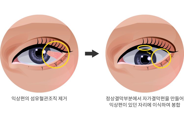 익상편 수술 과정 그림: 익상편의 섬유혈관조직을 제거한 뒤, 정상 결막 부분에서 자가결막편을 만들어 익상편이 있던 자리에 이식하여 봉합